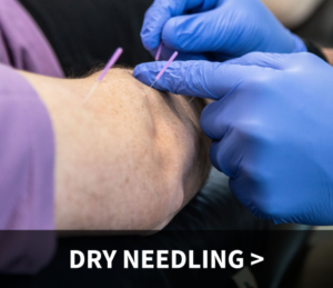 dry needling, physical therapist inserting dry needles into elbow